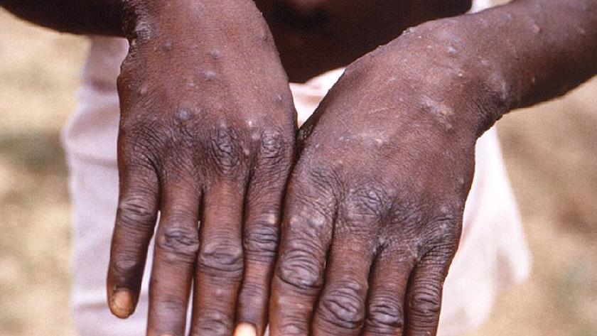 Iranpress: US confirms first case of monkeypox virus infection 