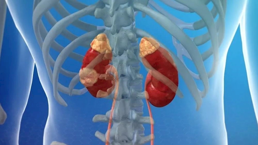 ایران پرس: علائم و درمان سرطان کلیه