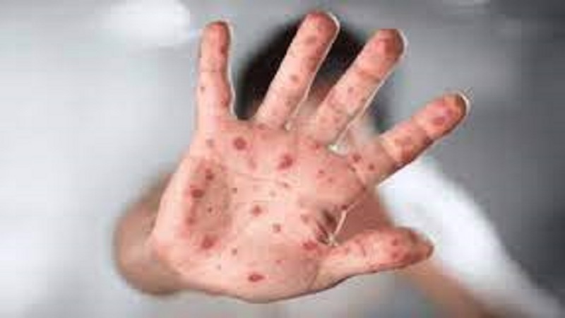 Iranpress: La variole du singe a atteint 20 pays à travers le monde