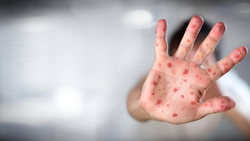 Iranpress: 80 cas de variole du singe confirmés par l